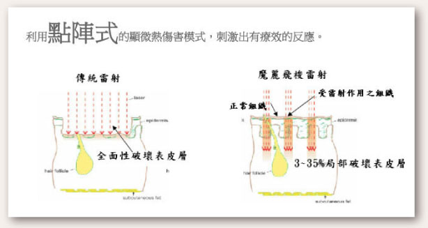 點陣式的顯微熱傷害模式-1